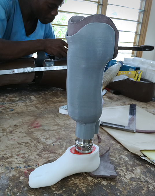 Impression 3D de prothèse avec HP&O